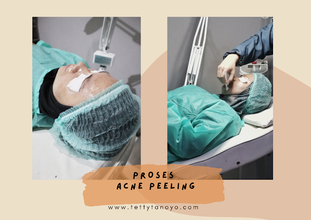 acne center cara mengatasi jerawat dengan acne peeling